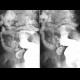 Entero-sigmoid fistula, enteroclysis: RF - Fluoroscopy